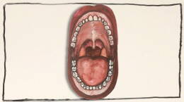 What are Tonsil Stones?
