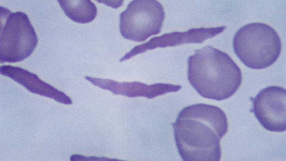 The blood cells of a person with sickle cell disease