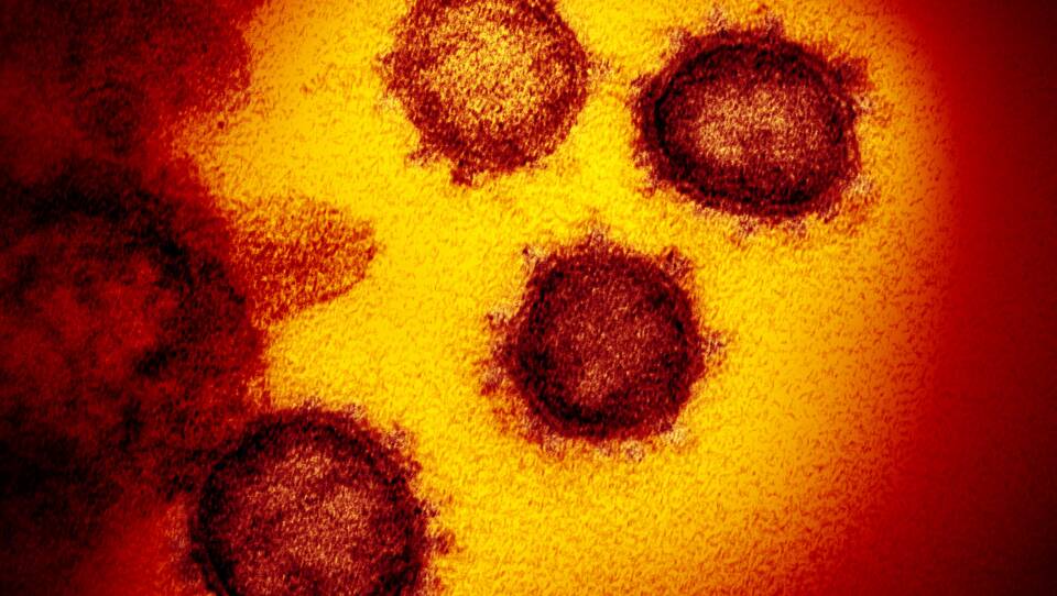 SARS-CoV-2 is shown in this colorized transmission electron micrograph. This specimen was isolated from a patient in the U.S. Particles of the virus are shown emerging from the surface of cells cultured in the lab.